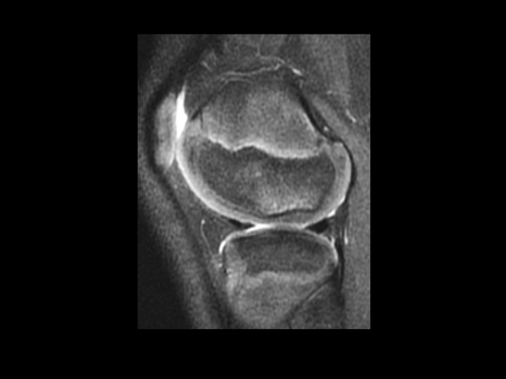Figure 3 for case normal developmental irregular ossification lateral femoral condyle